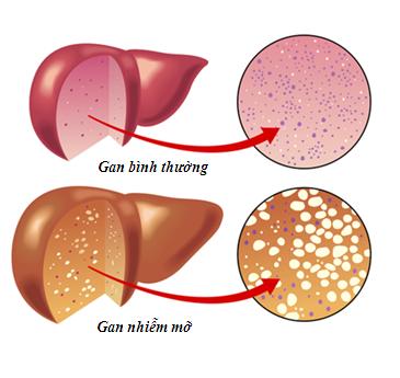 Cách điều trị gan nhiễm mỡ